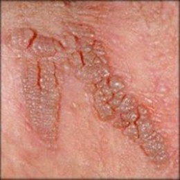 warts